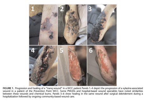 Wound